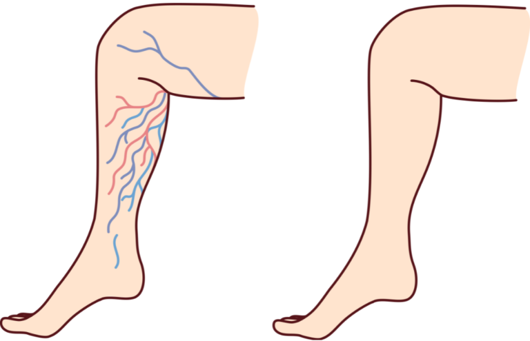 varicose veins