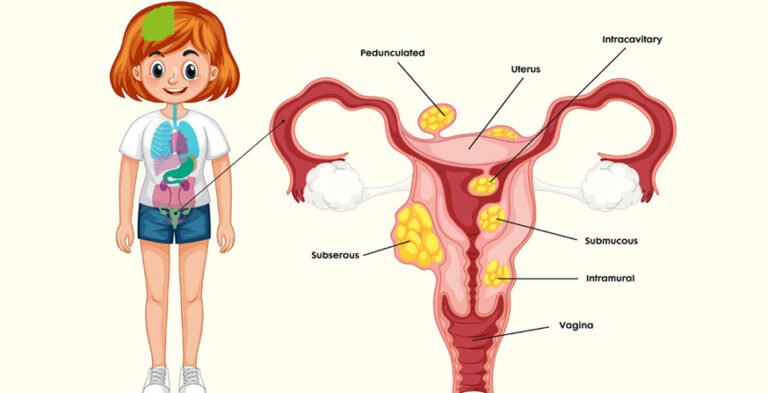 Uterine Fibroids Treatment