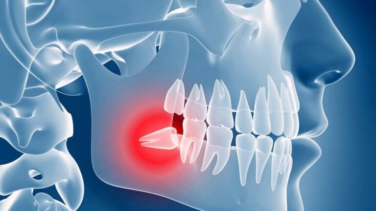 Impacted Wisdom Teeth Removal Surgery in Oxnard: Essential Guide