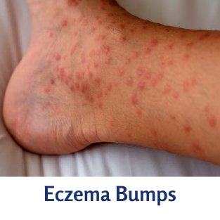 eczema bumps